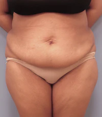 before abdominoplasty