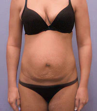 before mommy makeover