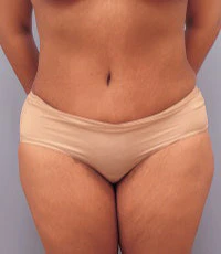 after abdominoplasty