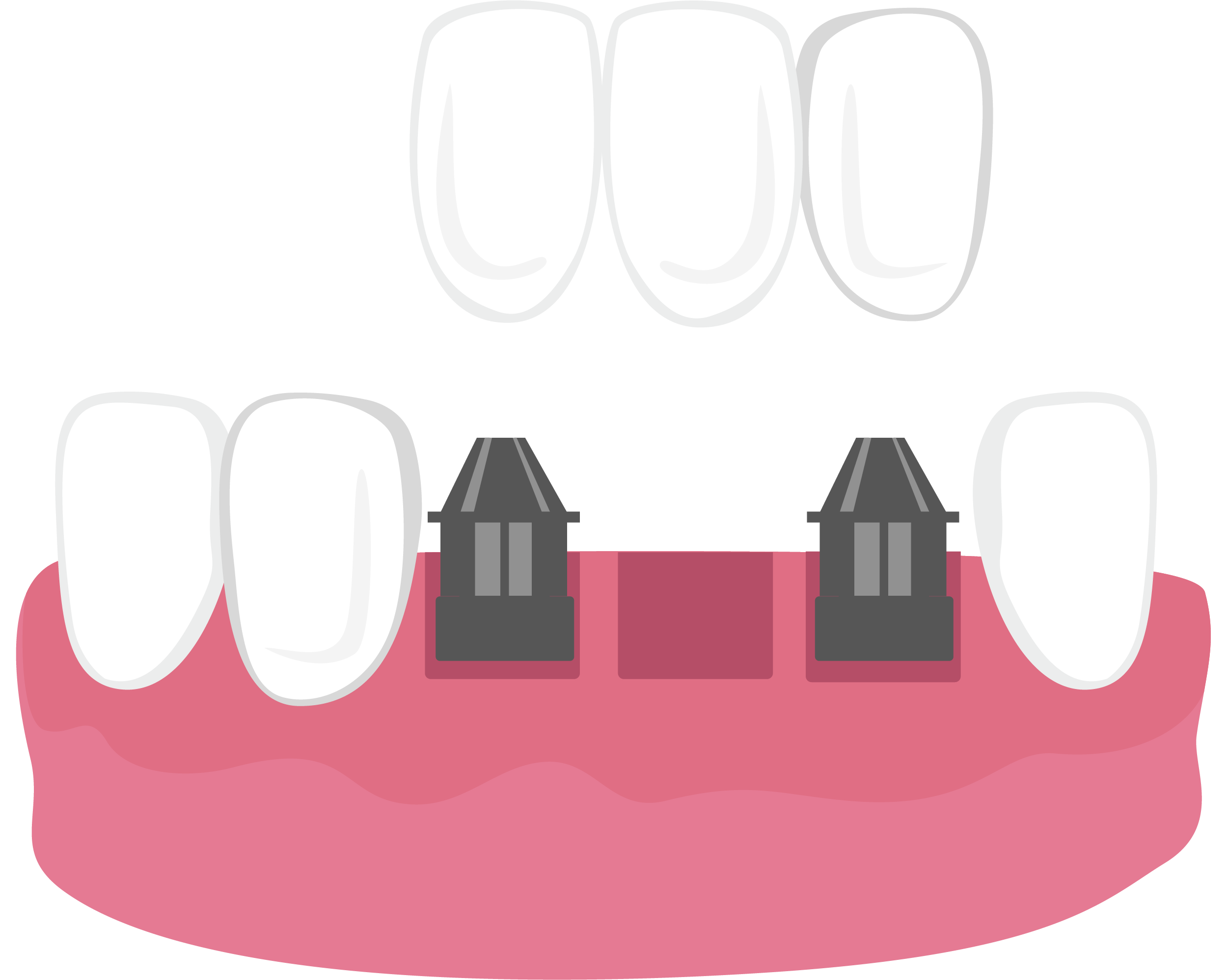 Illustration of dental bridge