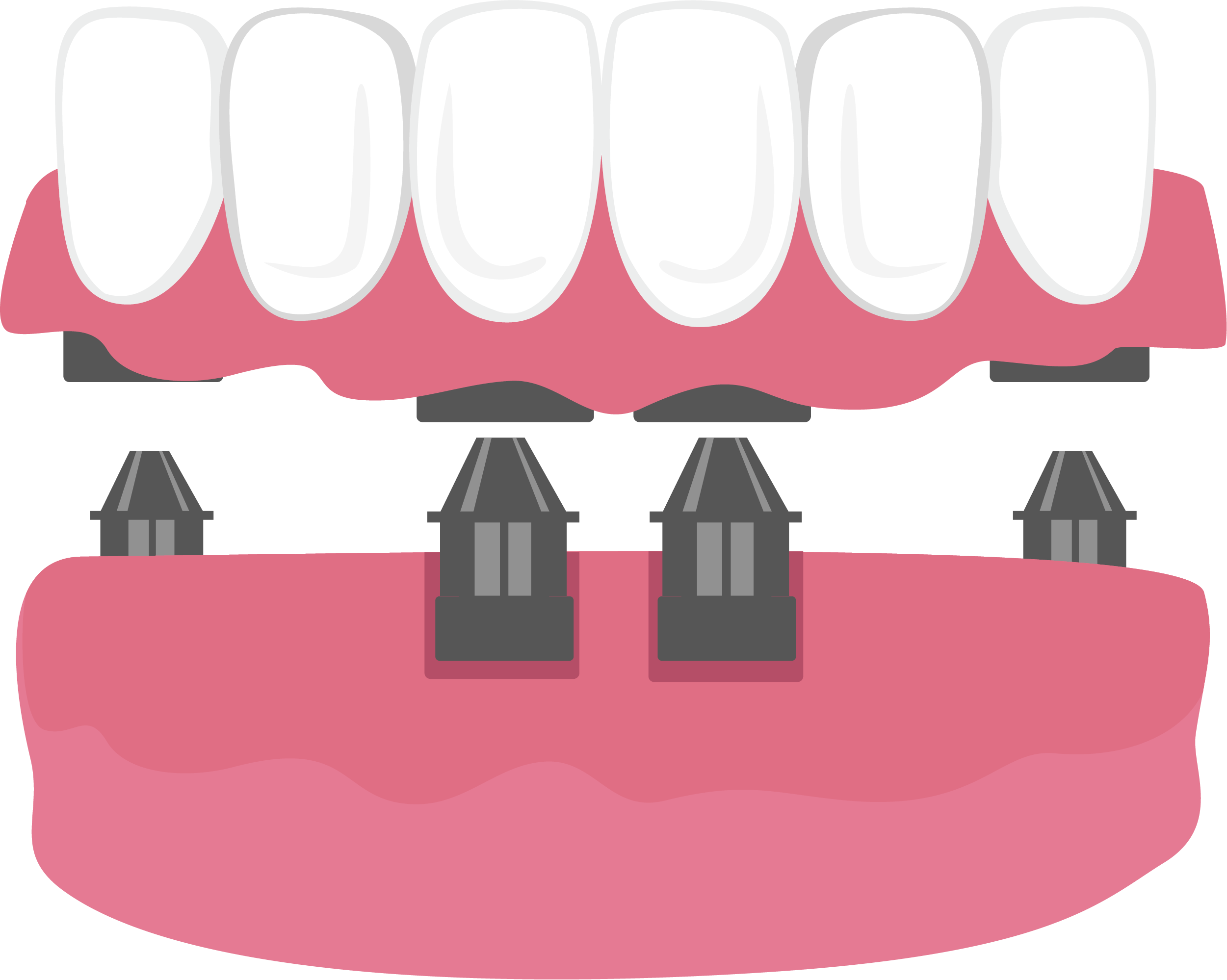Illustration of denture