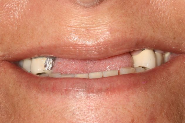 Victor R. Siegel, DDS patient before dental implants