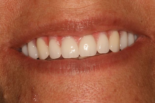 After denture