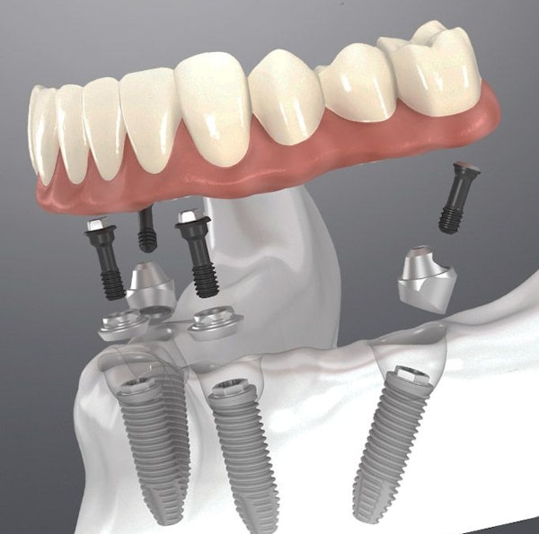All-on-4 implants