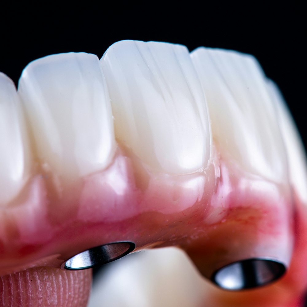 All on four implants