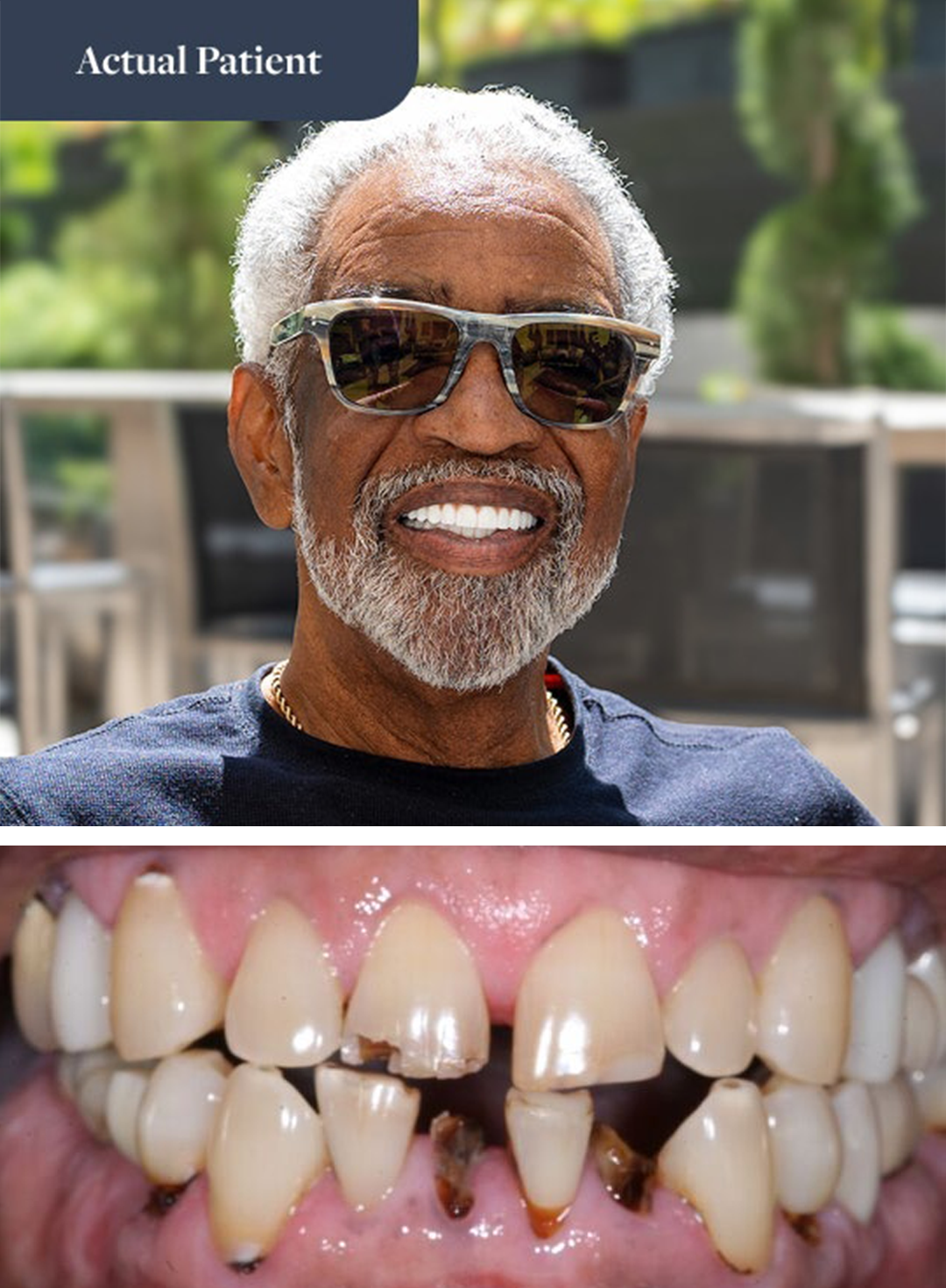 Before and after All-on-4