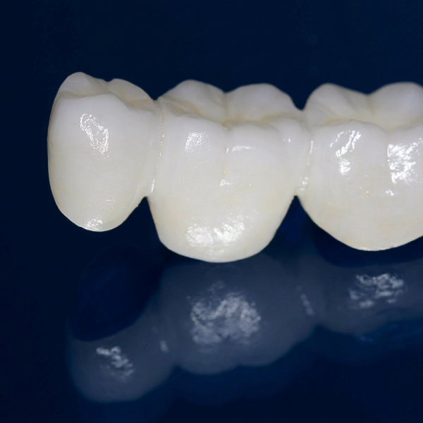 Dental Bridge