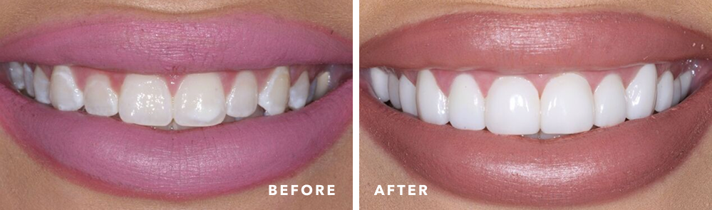 veneer patient before and after treatment