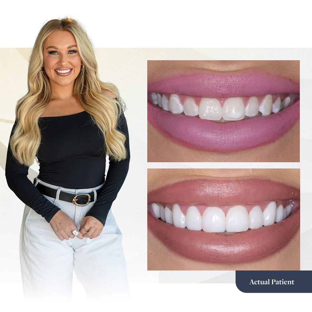 Real Patient before and after photos featuring a young woman with beautiful smile