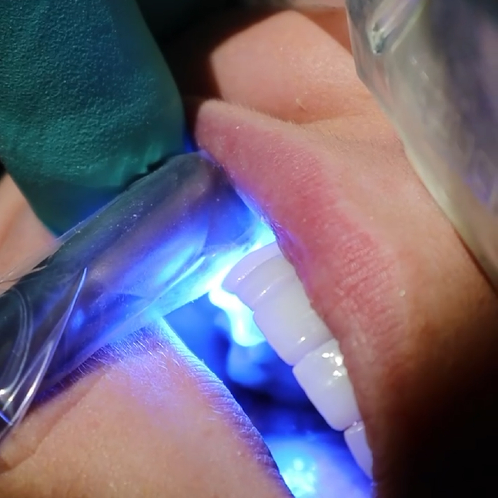 photo of uv light held against patient's mouth