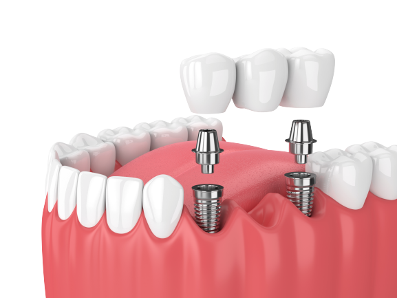 Implants being put in