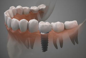 Single Dental Implants