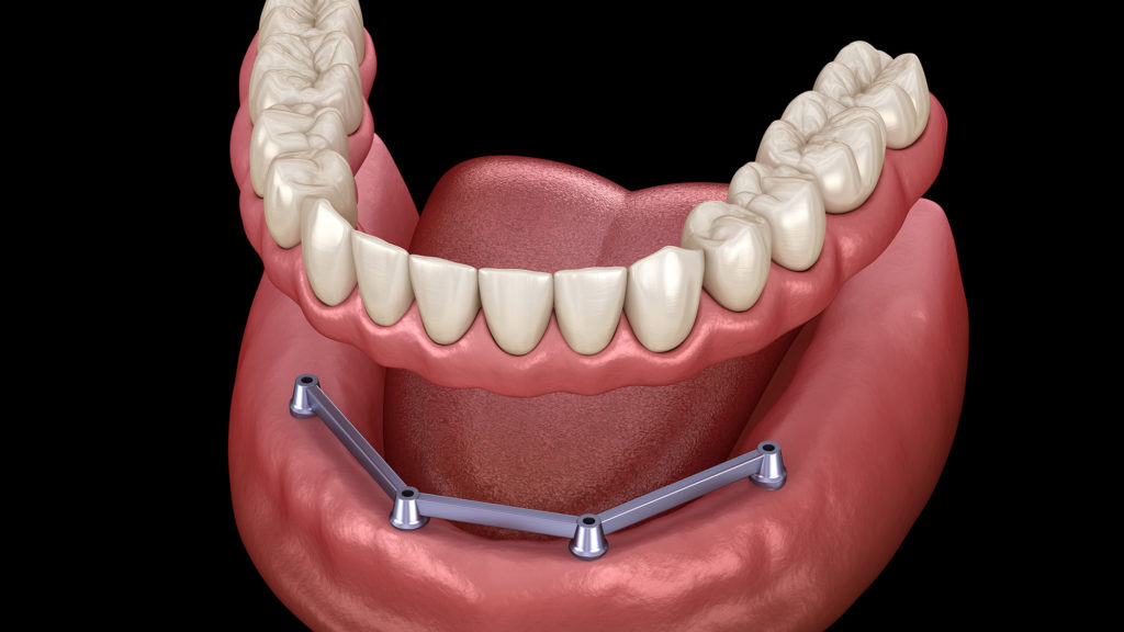 3D - model illustration of Bar-Retained Dentures