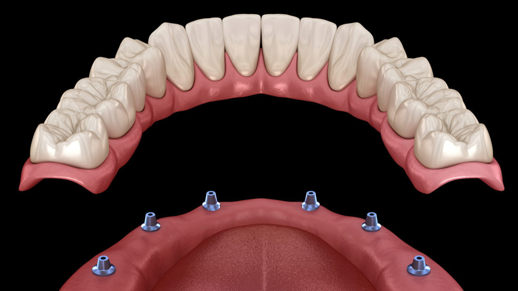 3D - model of Stud or Ball Retained Dentures
