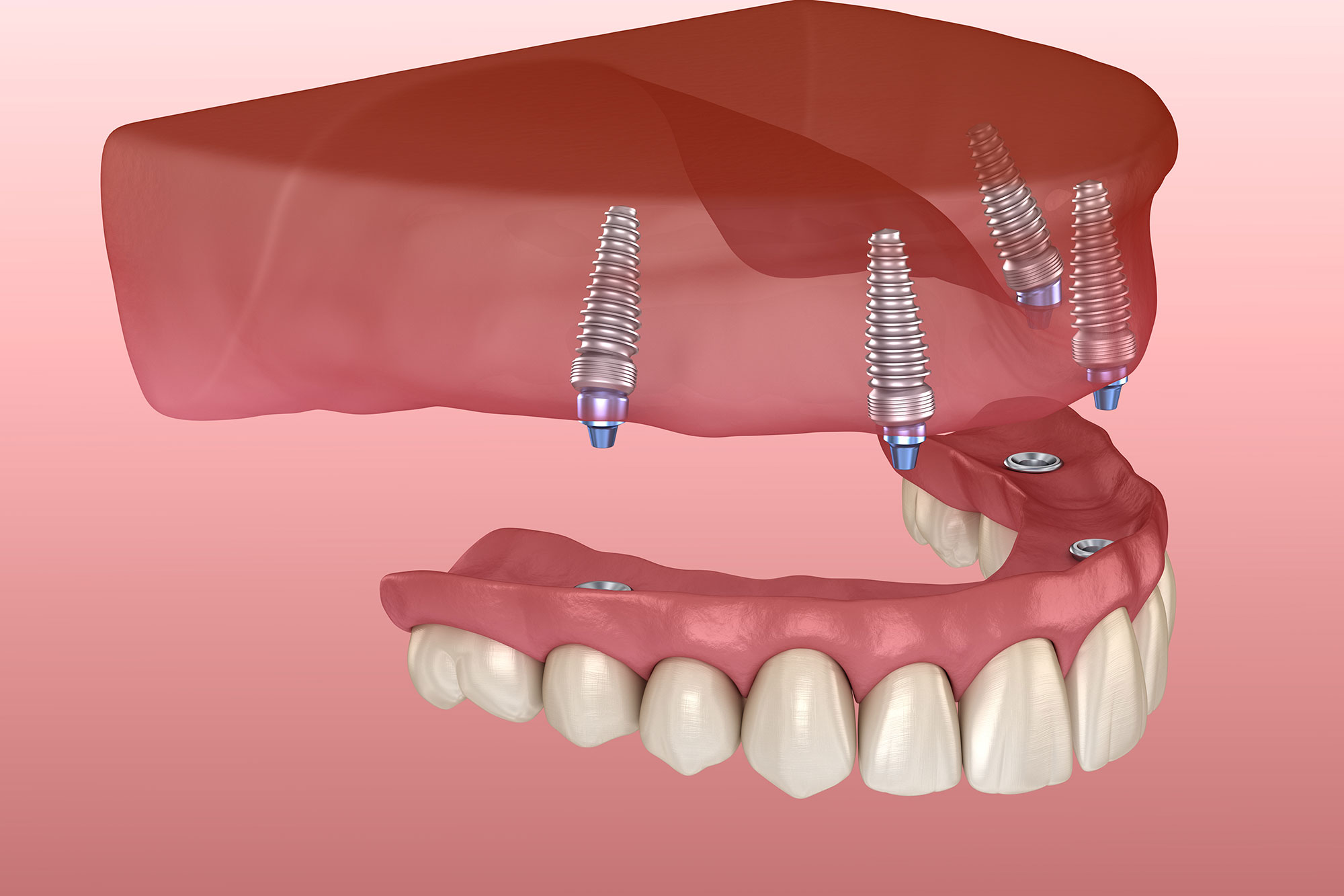 implant supported dentures 3d illustration
