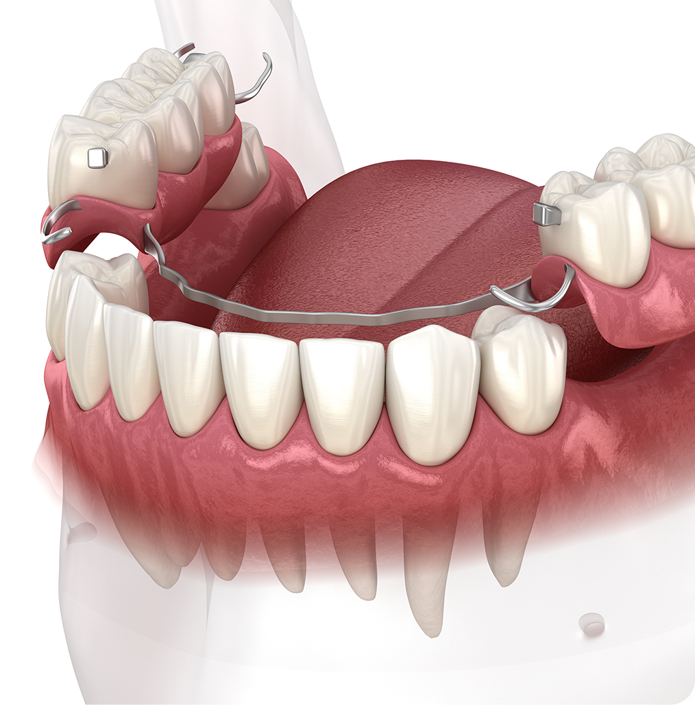 dentures diagram