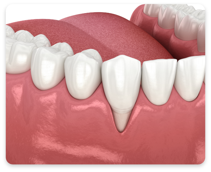 Illustration of gum recession showing exposed tooth root