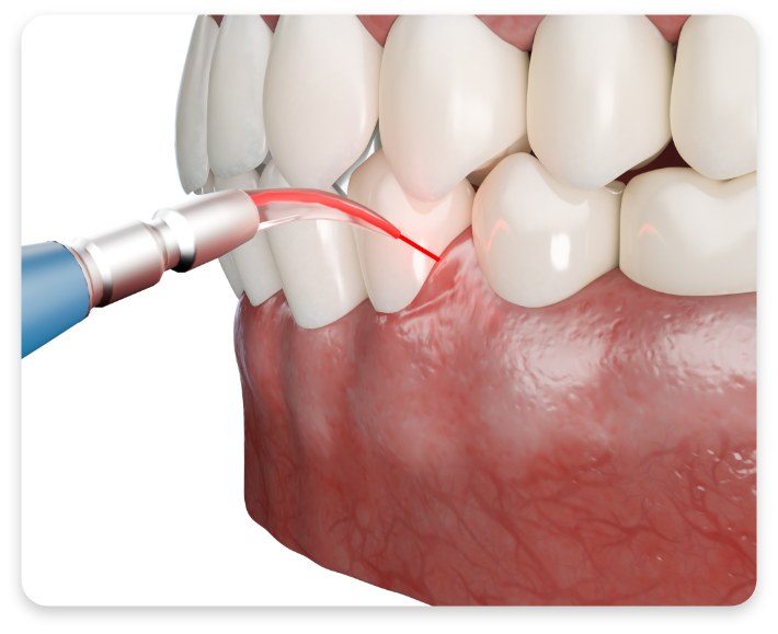 Dental laser applying LANAP treatment to inflamed gums