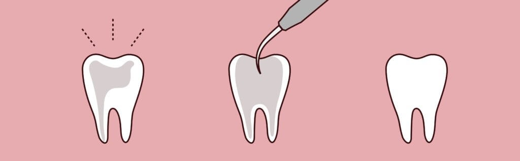 Root Canal Graphic