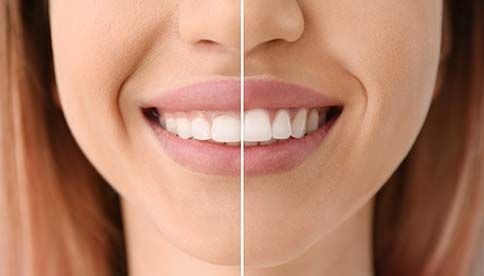 Before And After Crown Lengthening