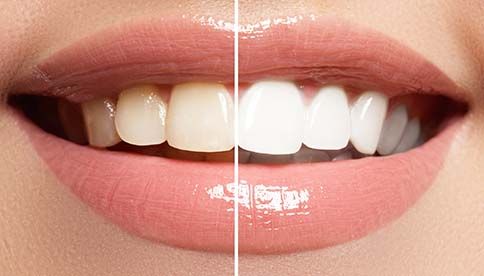 Before and After of teeth whitening