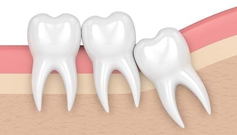 Impacted tooth