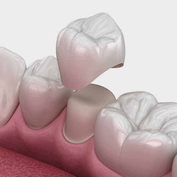 dental crown