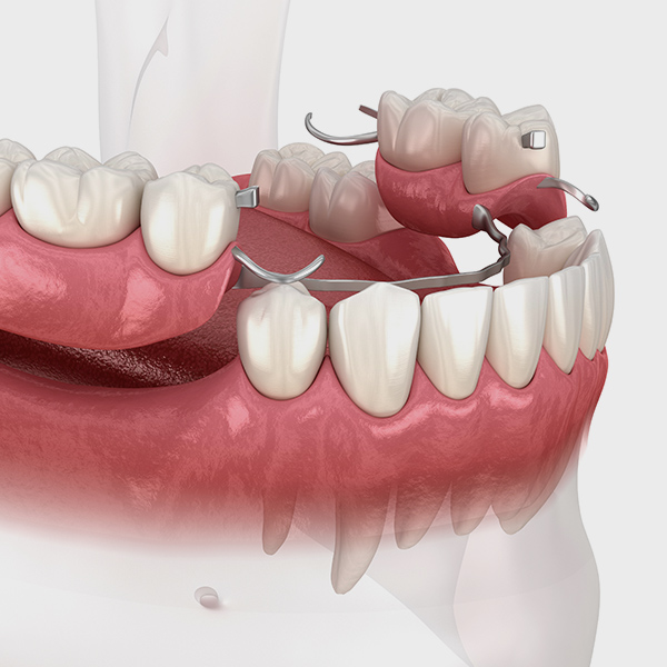 implant denture