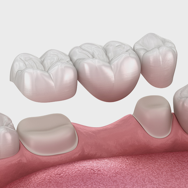 dental bridge