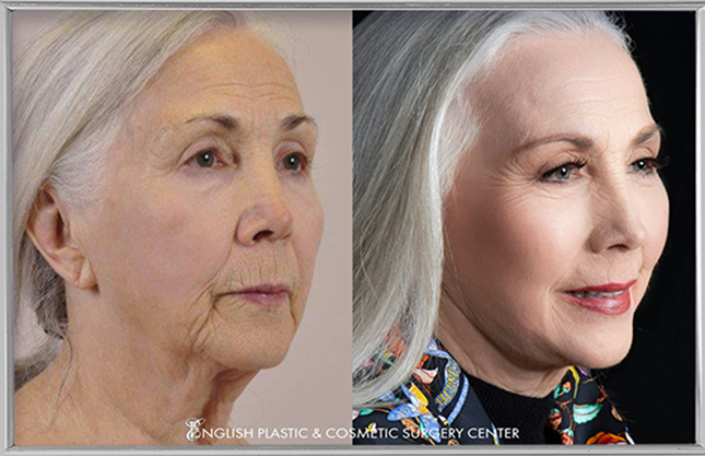Patient before and after cosmetic surgery