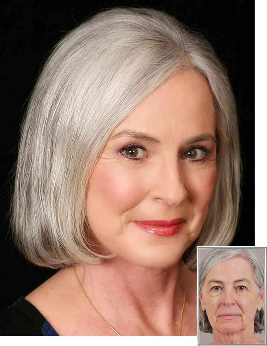 Mature patient before and after facial treatment