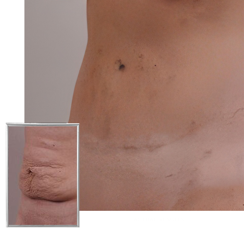 stretch marks and scarring