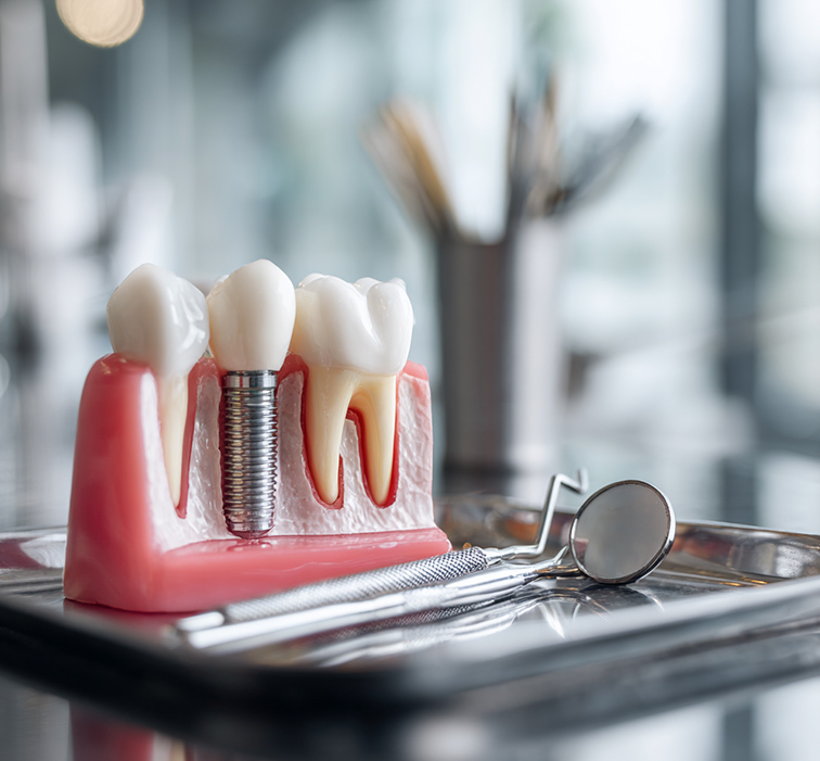 Dental implant model showing a metal implant screw beneath a dental crown, displayed on a dental tray with instruments.