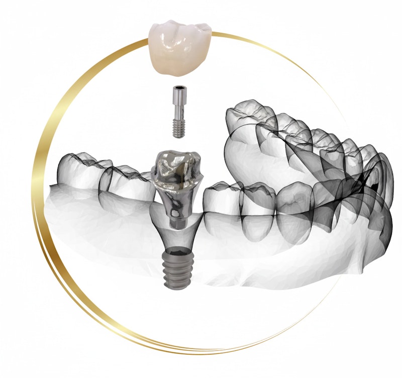 Implant to jawbone