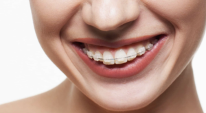 Woman smiling with braces