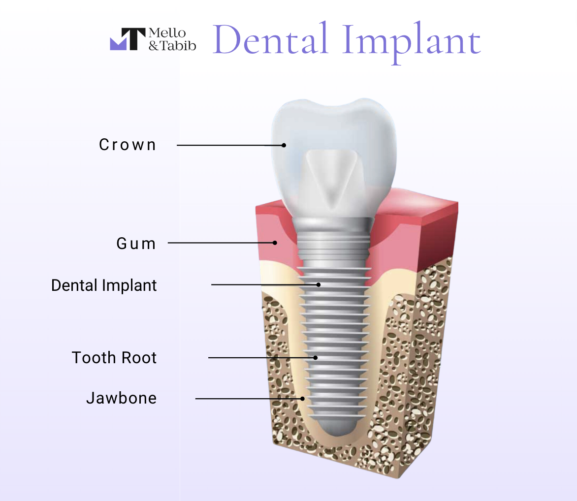 Dental Implant model diagram