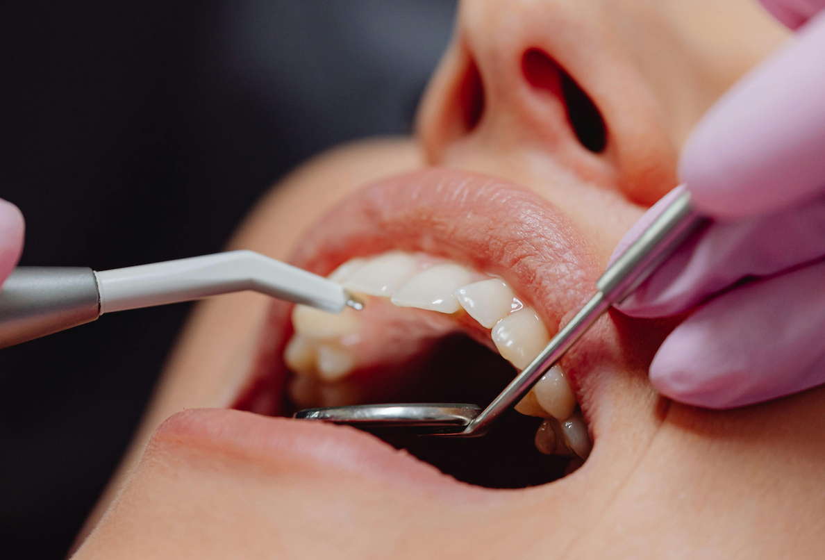 close up of mouth with dental tools