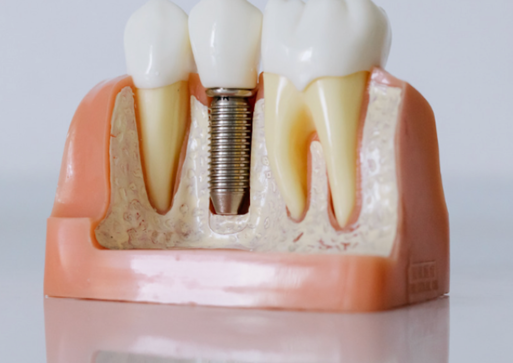 dental implant model