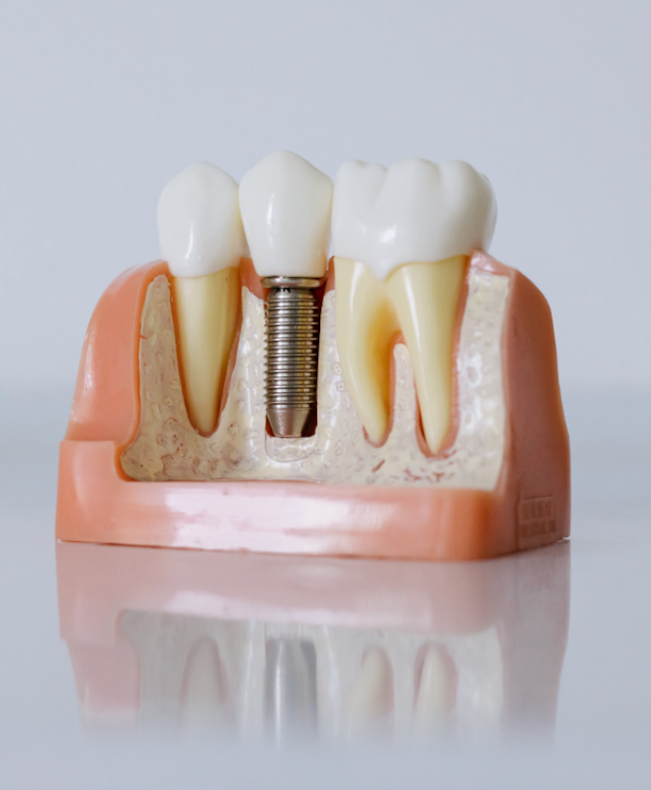 dental implant model