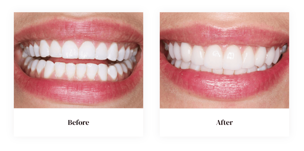 Before and After
