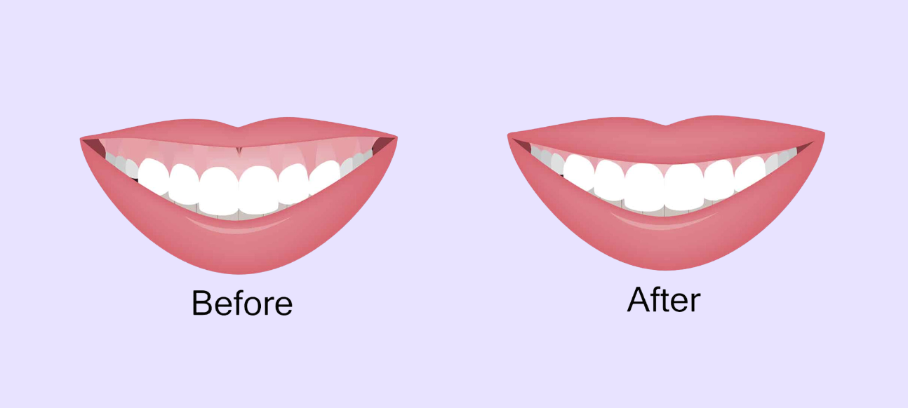Before and after illustration