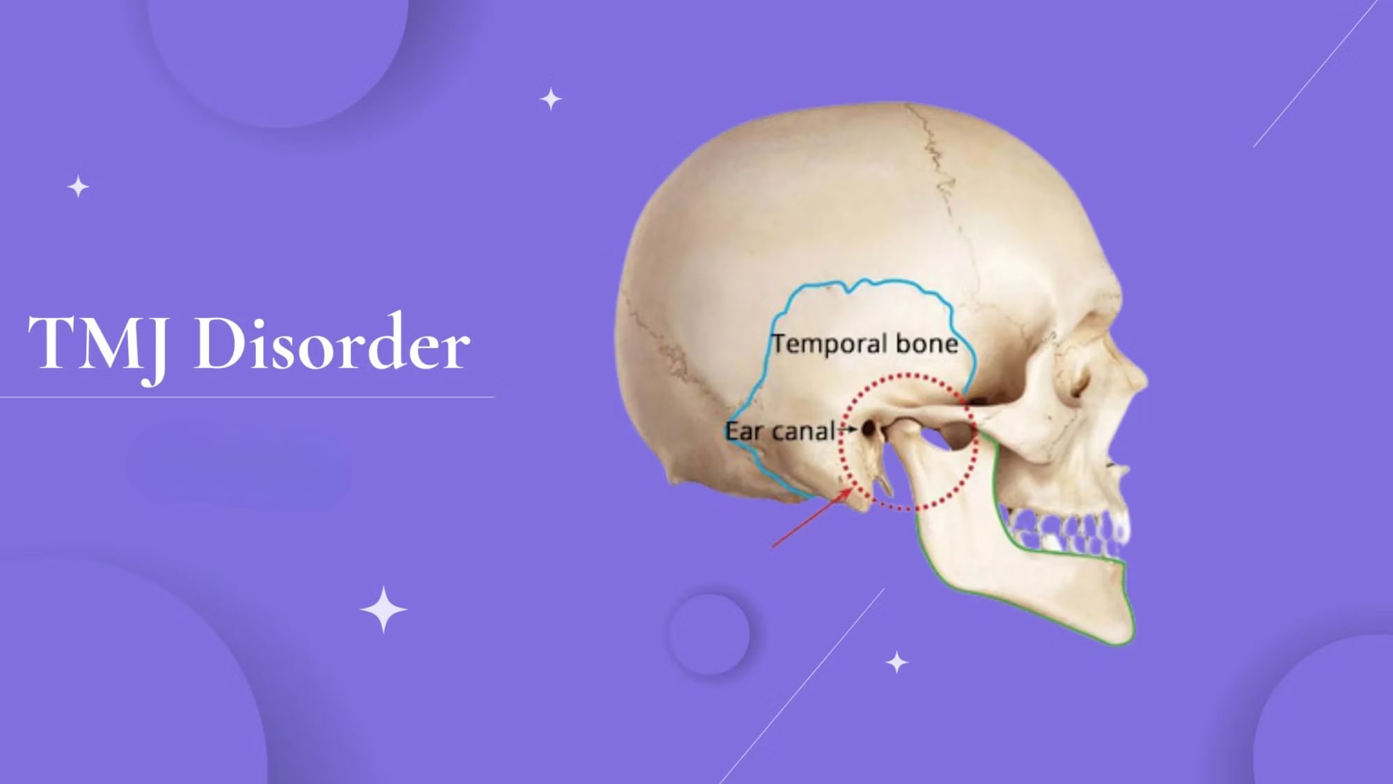 understanding tmj graphic showing the temporal bone on a skull