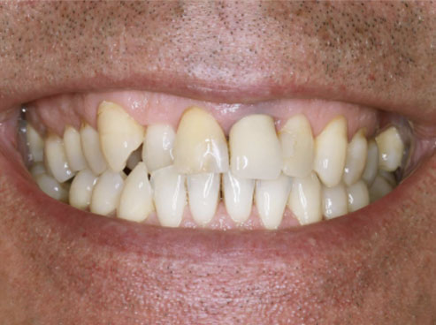 image of teeth before treatment