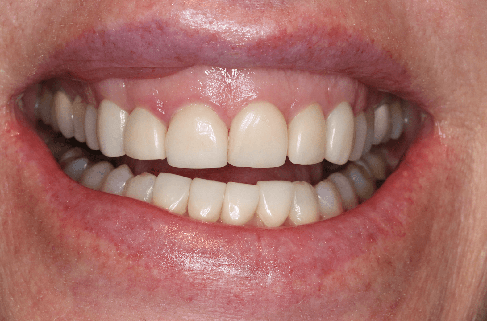 Heather before gummy smile treatment