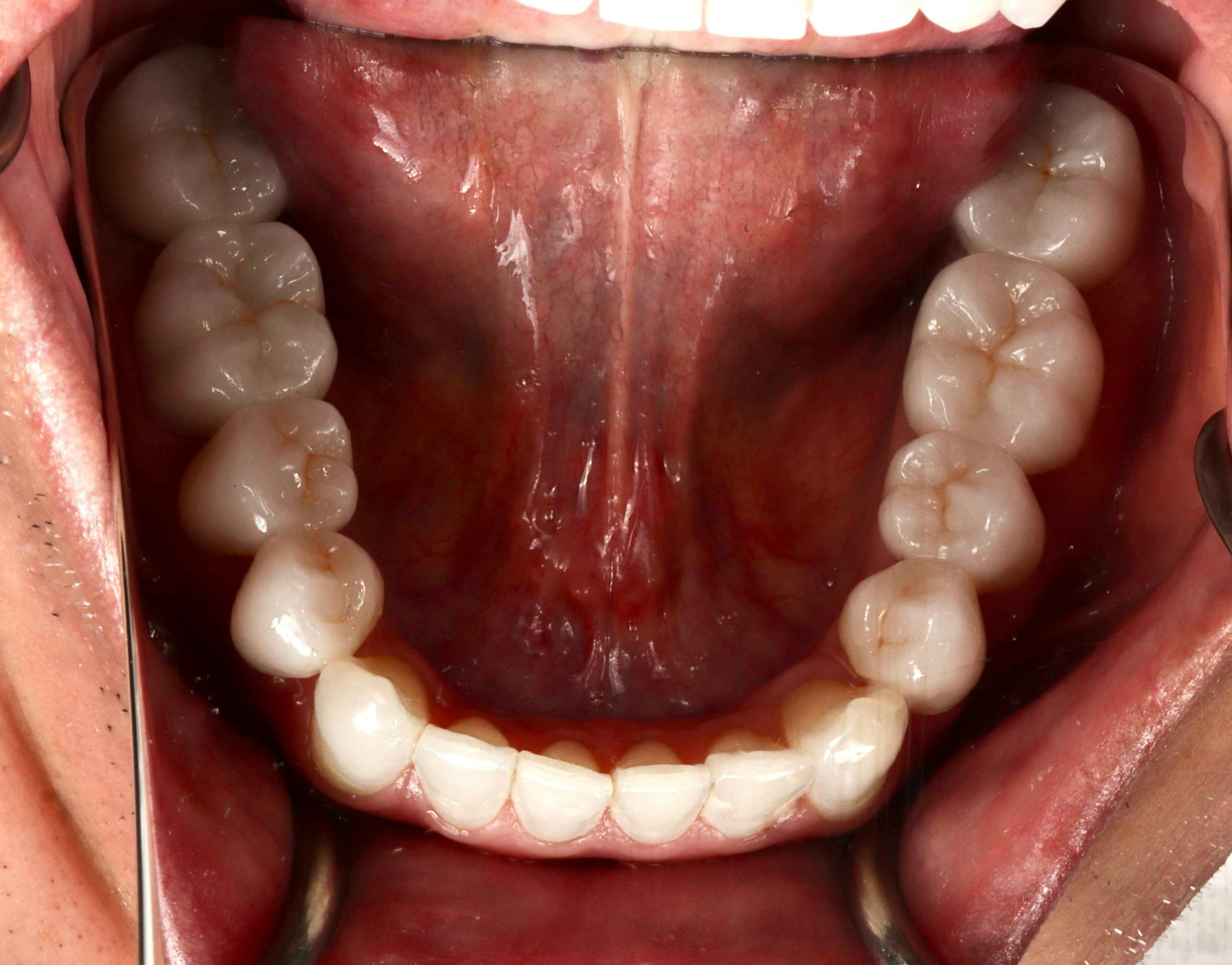 image of teeth after treatment