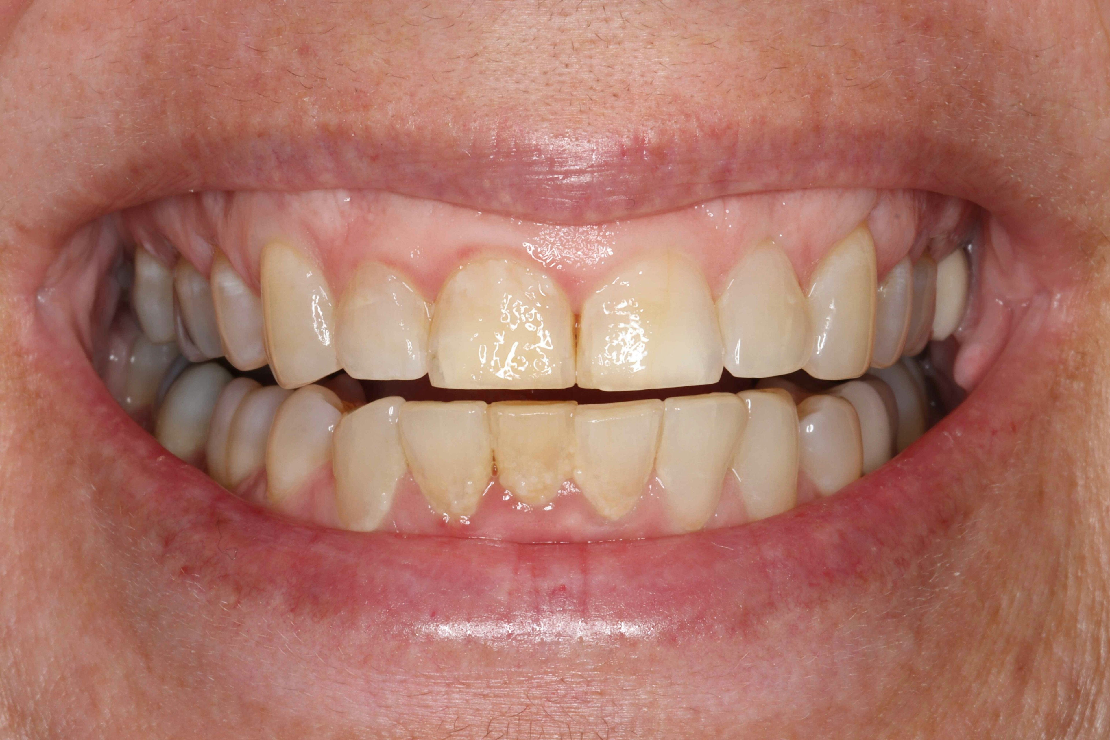 image of teeth before treatment