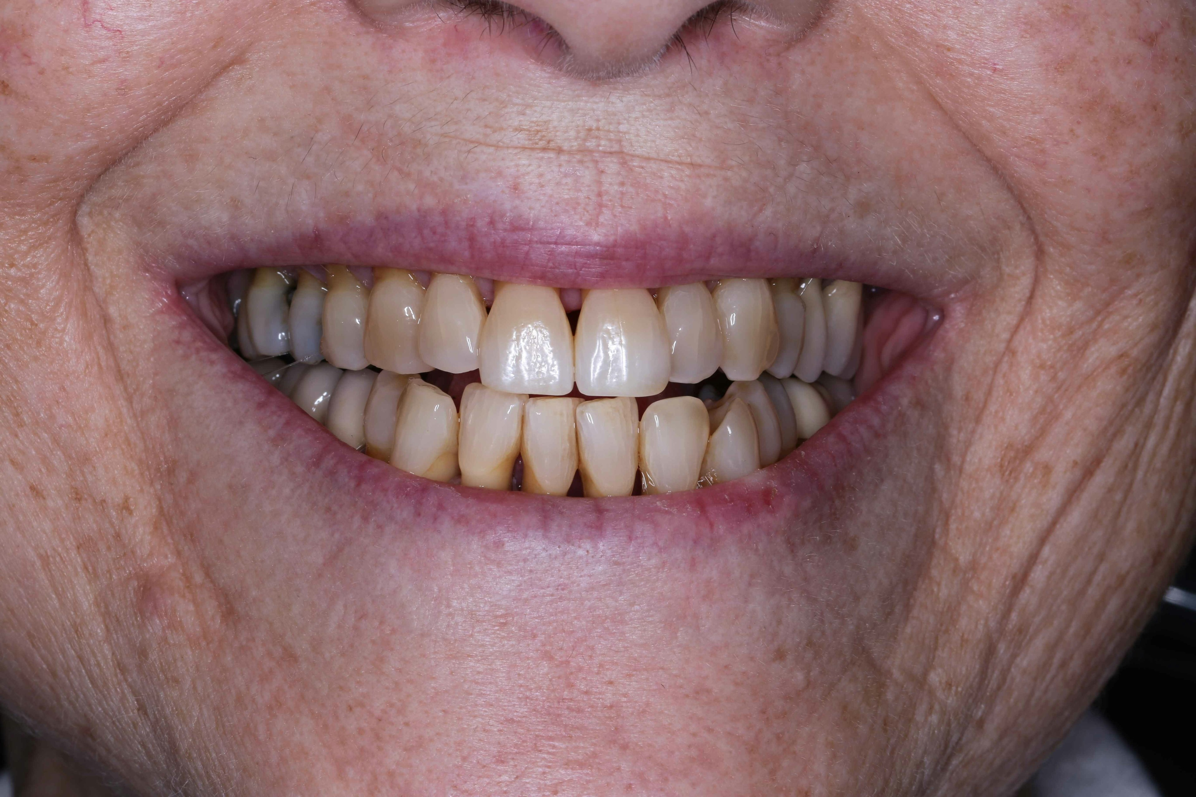 image of teeth before treatment