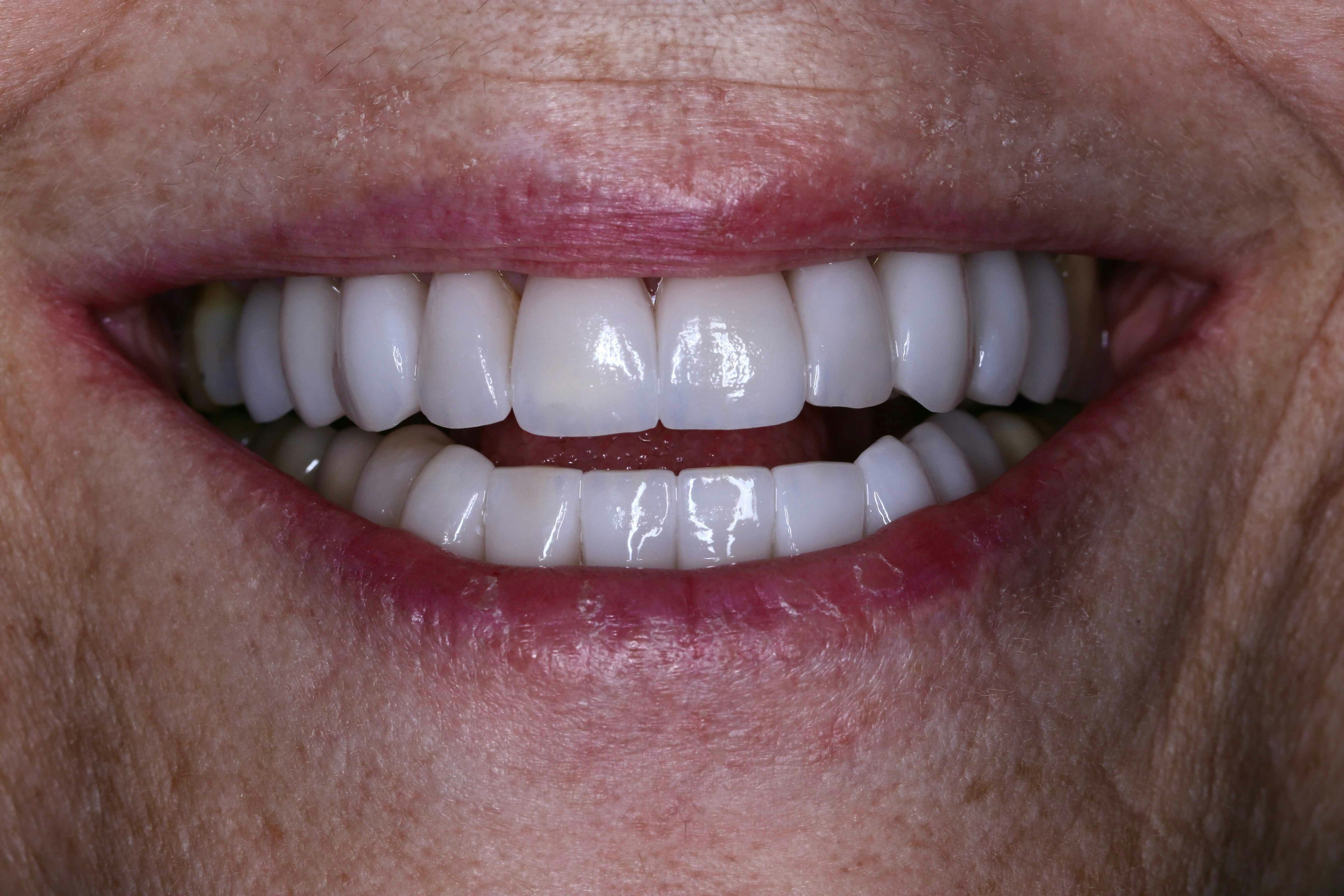 image of teeth after treatment