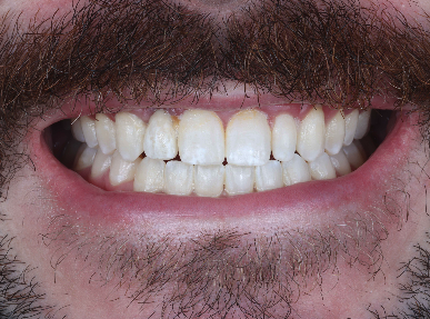 image of teeth before treatment