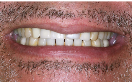 image of teeth before treatment